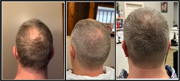 John King Bald Spot.png