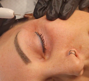 non surgical upper blepharoplasty treatment using plasma fibroblast in Joondalup