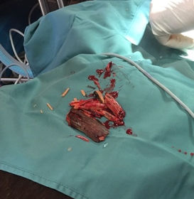 Unfortunate stick incident