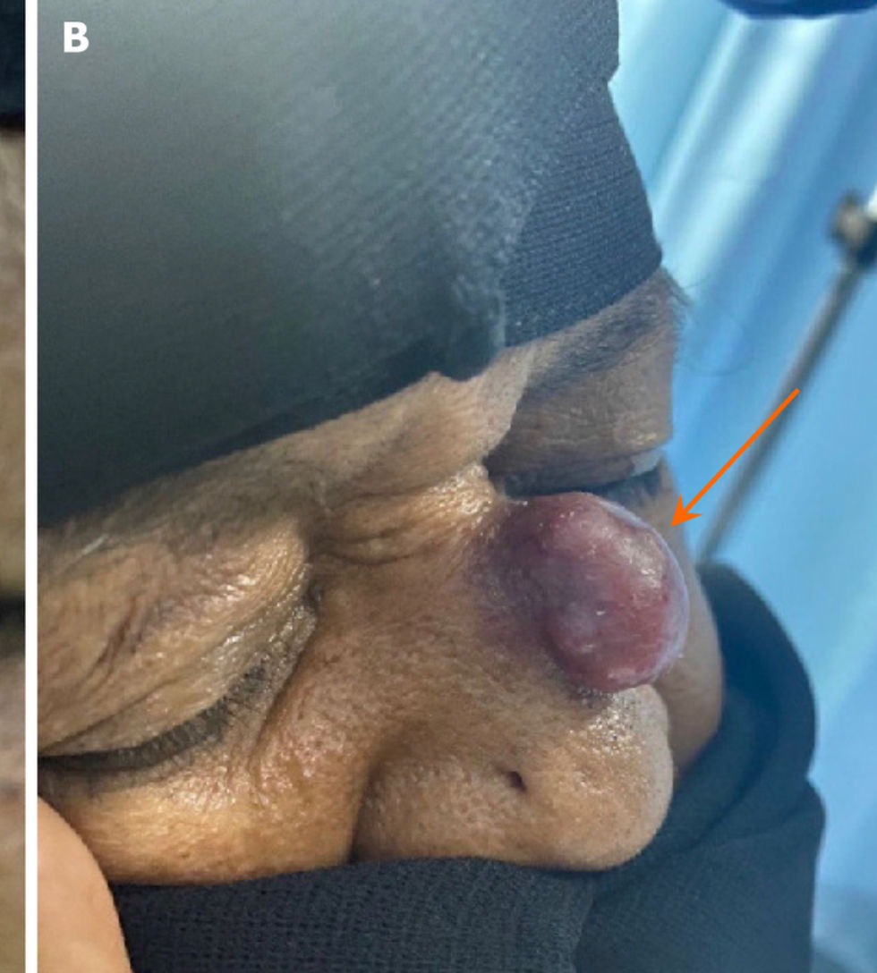 الدكتور فريد الغامدي عن سرطان الجلد ميركل