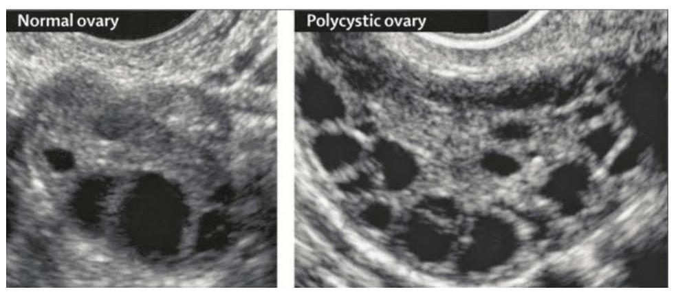 Sindromul Ovarelor Polichistice (SOPC)