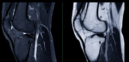 magnetic-resonance-imaging-knee-joint-260nw-2365447785_edited.jpg