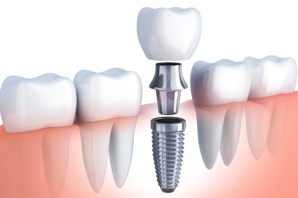 Dental-implant.jpeg