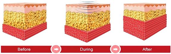 Hifem (High Intensity Focused Electromagnetic Field)