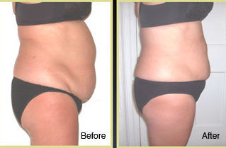 Cary, NC Fat Loss
