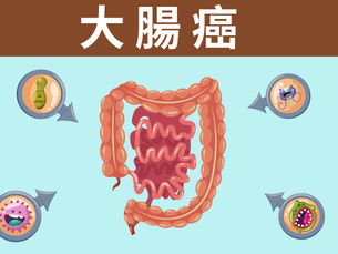 【大腸癌】 | 大腸癌介紹