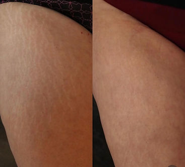 Stretch marks legs closeup.jpg