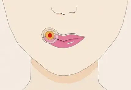 Naviga tra i nostri prodotti fitoterapici dedicati al trattamento dell'Herpes. Supporta la tua pelle con soluzioni naturali mirate, promuovendo la guarigione e il comfort cutaneo.
