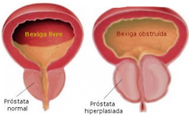HBP_prostata-300x181.png