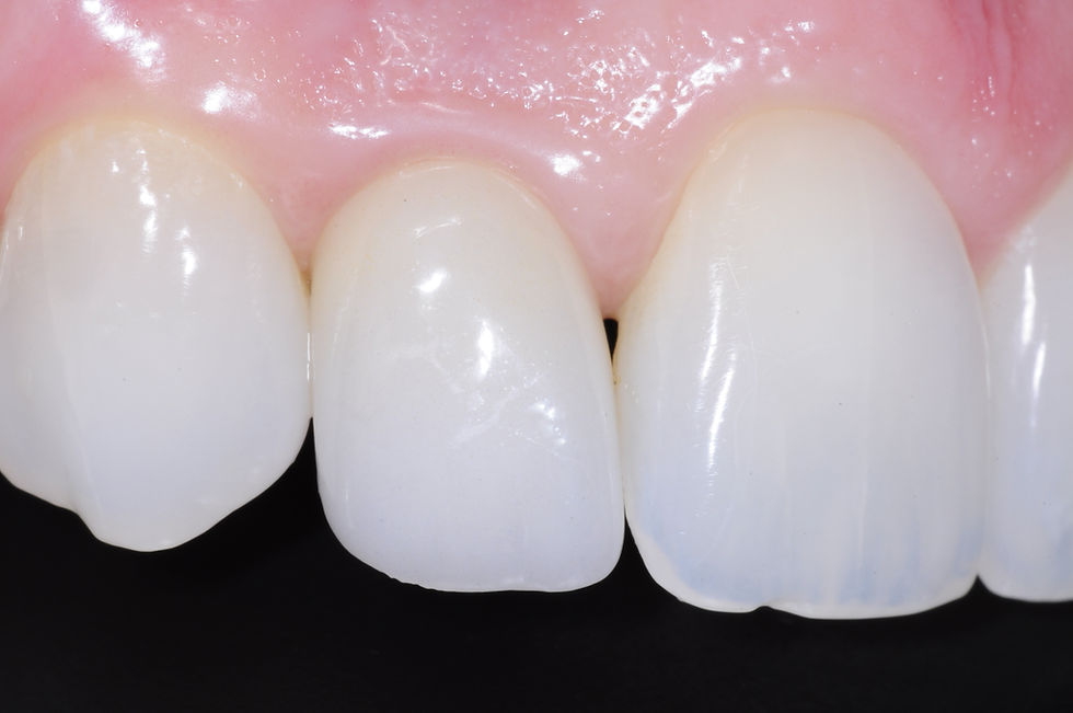 Dental Implant Therapy Kitchener Waterloo Prosthodontics