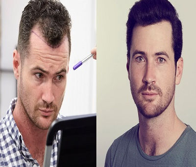 استكشاف فوائد زراعة الشعر في عيادة إنفيلد الملكية