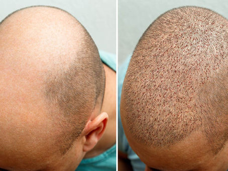 كيفية اختيار زراعة الشعر المناسبة لك