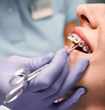 Paciente con Braces 