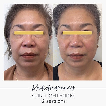 Radiofrequency Skin Tightening Before and After