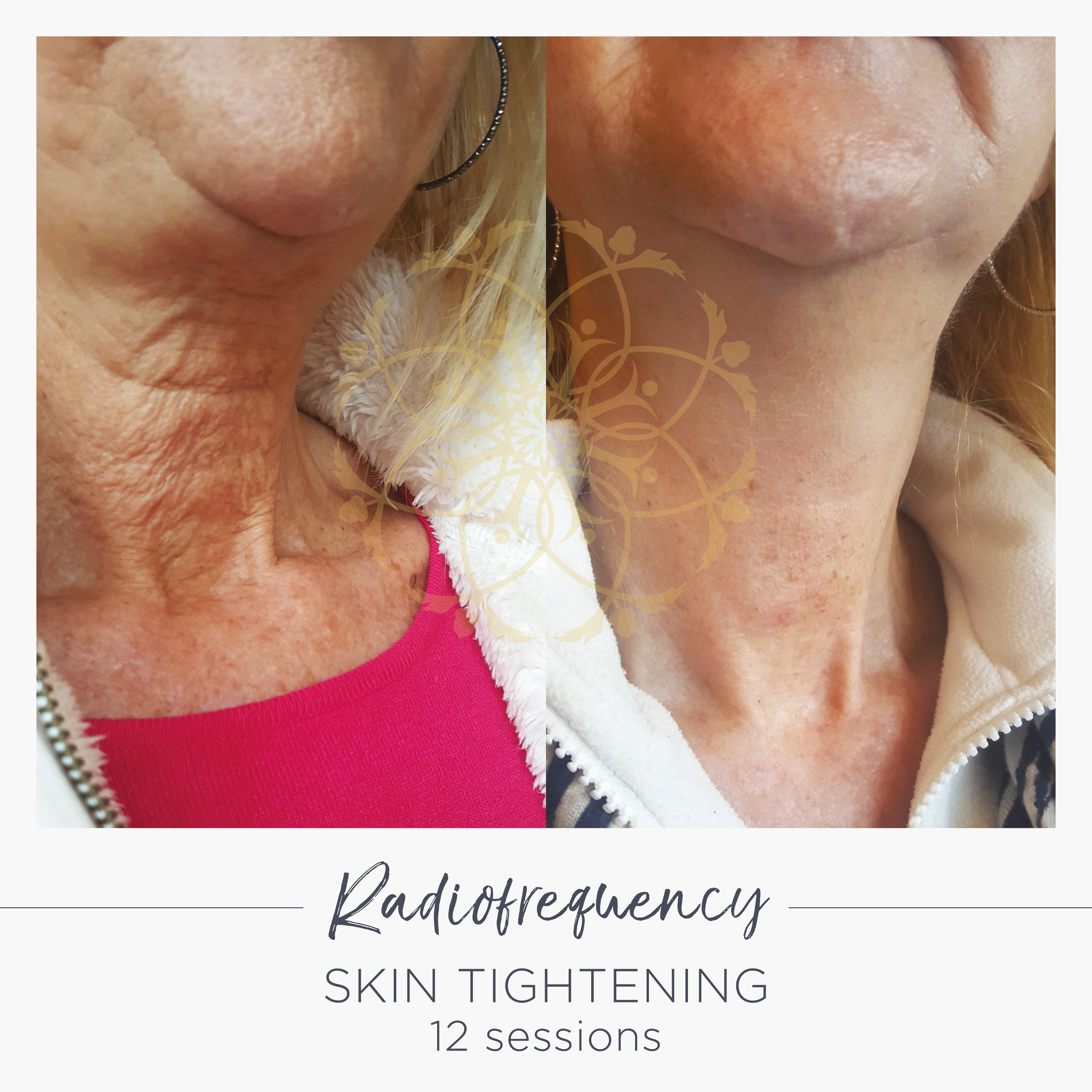 After radiofrequency treatment