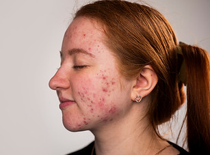 Many pimples Girl with bad skin Hormonal acne, puberty Skin acne background Closeup acne p