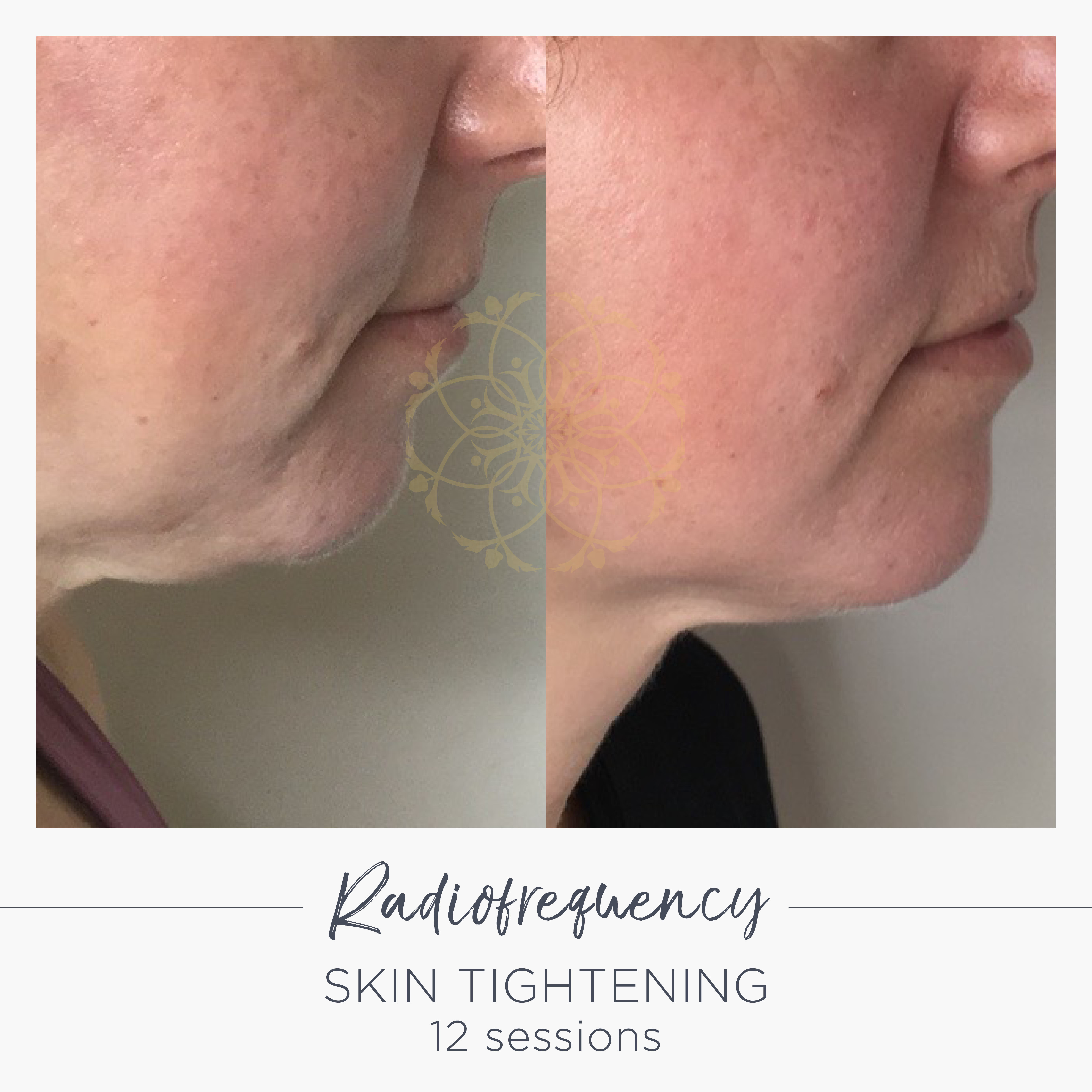 Before radiofrequency treatment