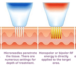RF-Microneedling-process.png