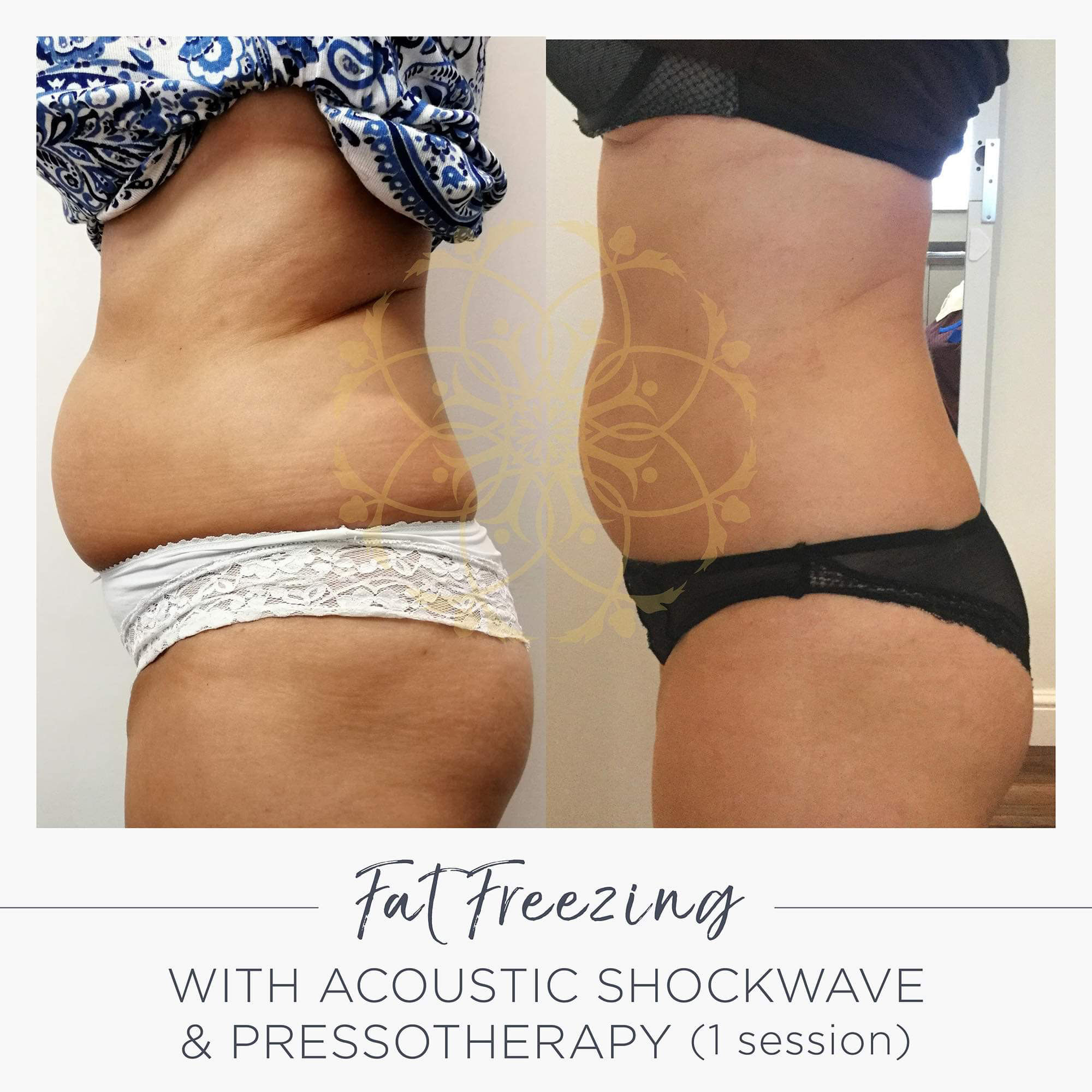 My experience with abdominal fat freezing.