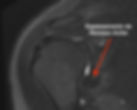 Ressonância magnética de ombro com capsulite