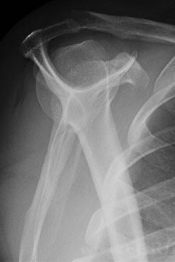 RX normal