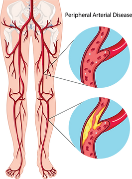 Peripheral Artery Disease Treatment Doctor Heart and Vascular Consultants in Detroit and Livonia Michigan