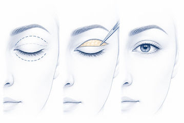 Blepharoplastie à la Réunion