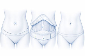 Abdominoplastie à la Réunion