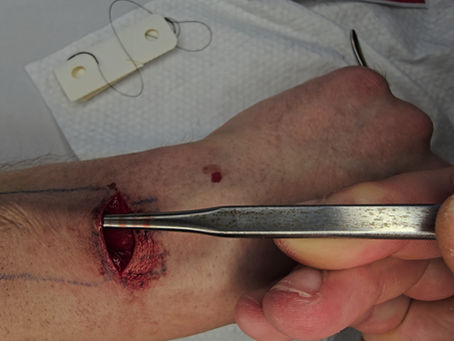 The Operation.  Video 3.  Video 4 Soon.