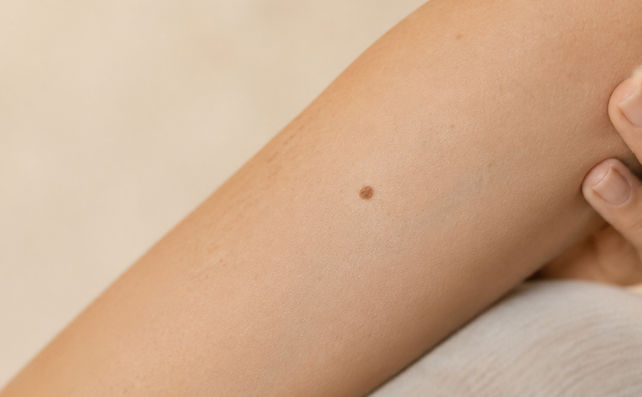 Dr. Nitzsche Gutartige Hautveränderung Laser.jpg