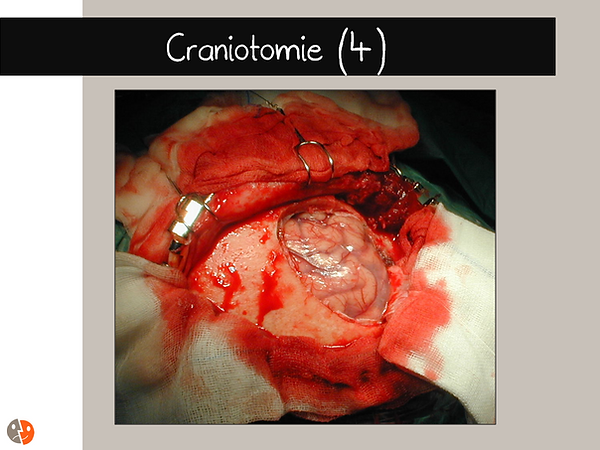 Craniotomie: Dure-mère ouverte