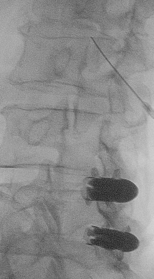 Radiographie lombaire oblique: Aiguille dans la fente L2-L3