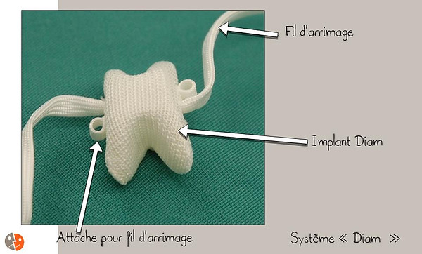 Diam: impant avec attaches