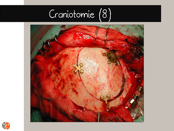 Craniotomie: Remise en place du volet osseux