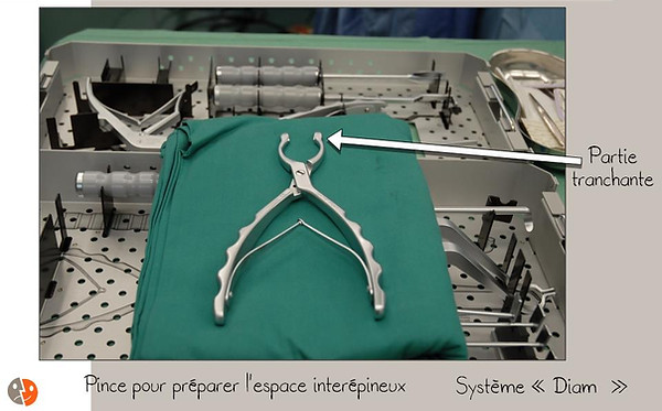 Diam: préparation de l'espace interépineux
