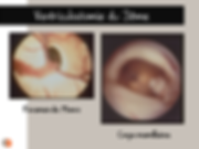 Vue intraventriculaire du foramen de Monro et des corps mamillaires