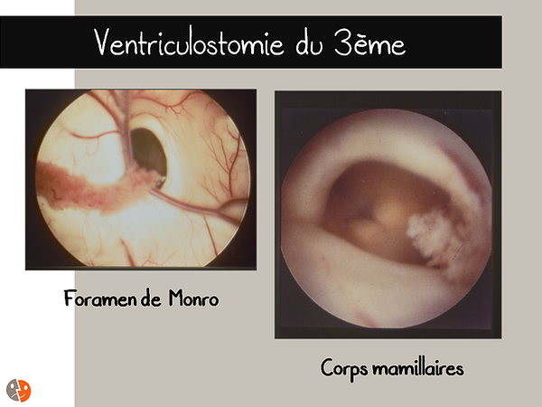 Vue intraventriculaire du foramen de Monro et des corps mamillaires
