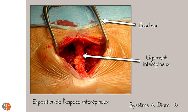 Diam: Ouverture pour implantation