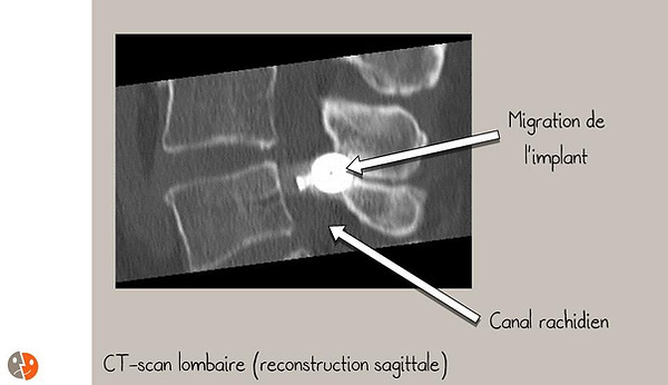Aperius: Complication