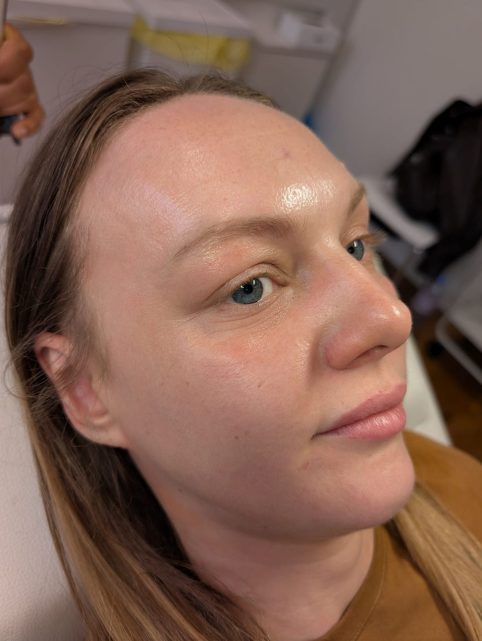 Before dermal filler treatment, restoring facial volume