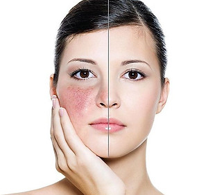Piel con rosacea