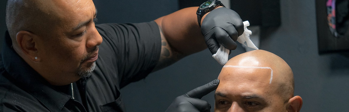 Hairline restoration with natural results