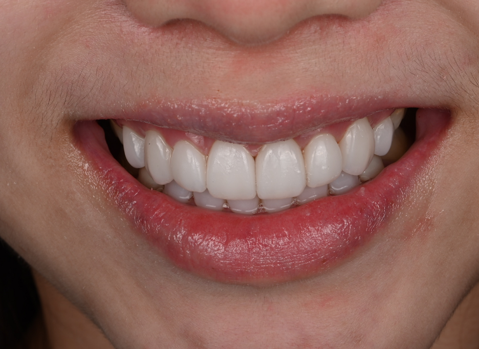 cara membersihkan veneer gigi