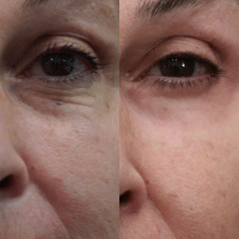 Peeling de Fenol