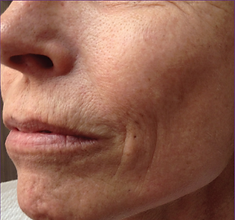 Intensif wrinkles treatment before.PNG