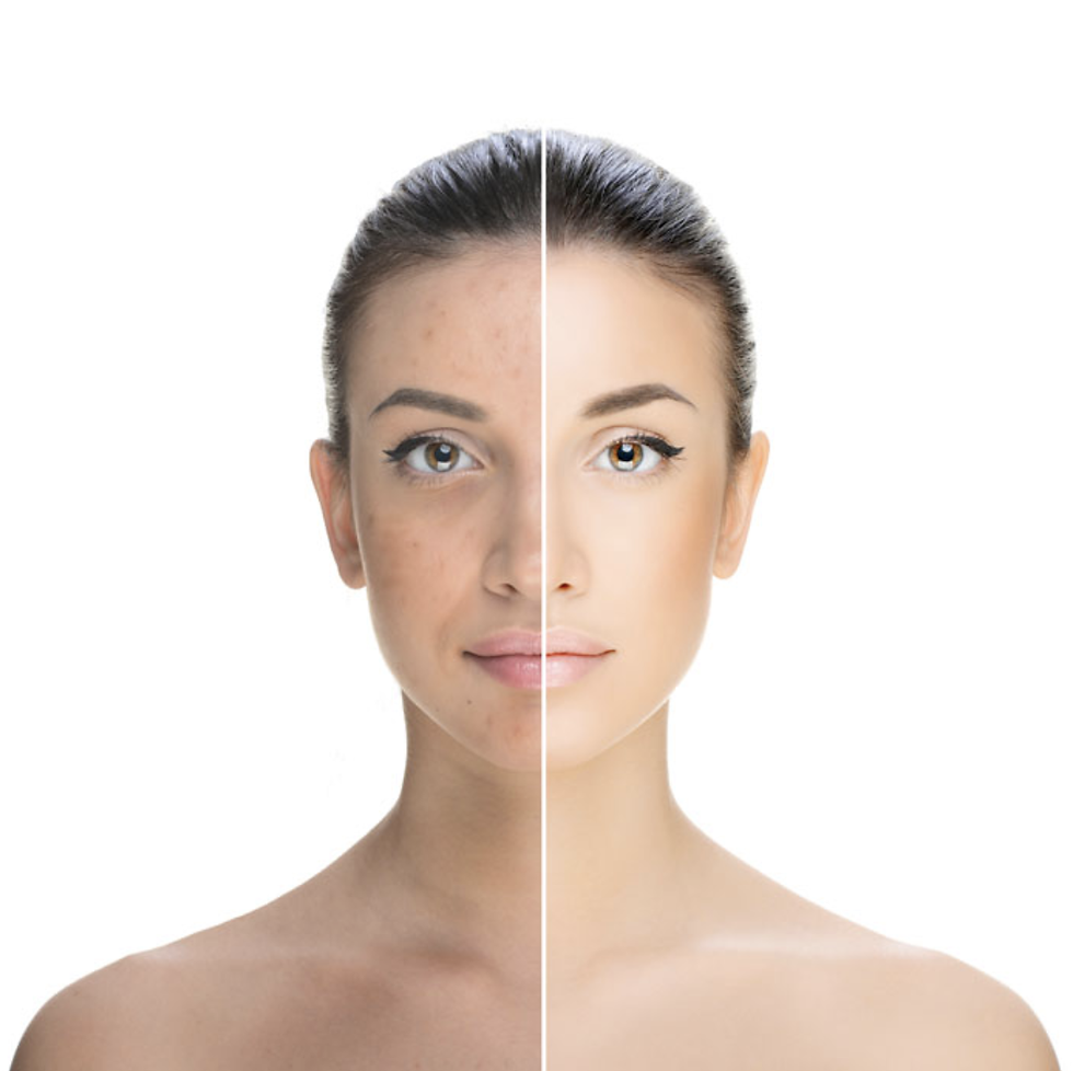 hyperpigmentation treatment kolkata- Dr Vohra's Skin Clinic | Skincredible