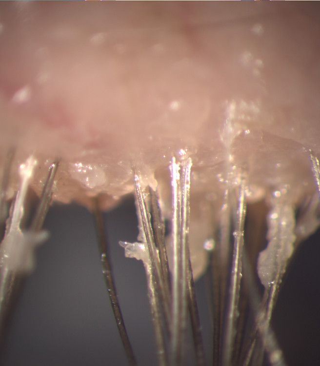 Demodex Blepharitis