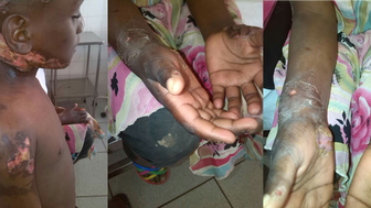 Tia paterna queima dois sobrinhos de 7 e 9 anos