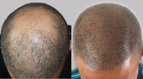 smp-hair-loss-4.jpeg