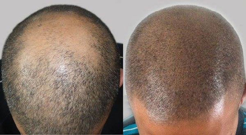 smp-hair-loss-4.jpeg